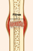 Corte transversal de un hueso fracturado que muestra fibras que forman un coágulo sanguíneo en el lugar de la fractura.