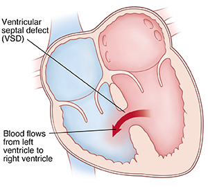 Front view cross section of heart showing ventricular septal defect (VSD) allowing blood to flow from left ventricle to right ventricle.