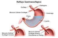 Ilustración del reflujo gastroesofágico